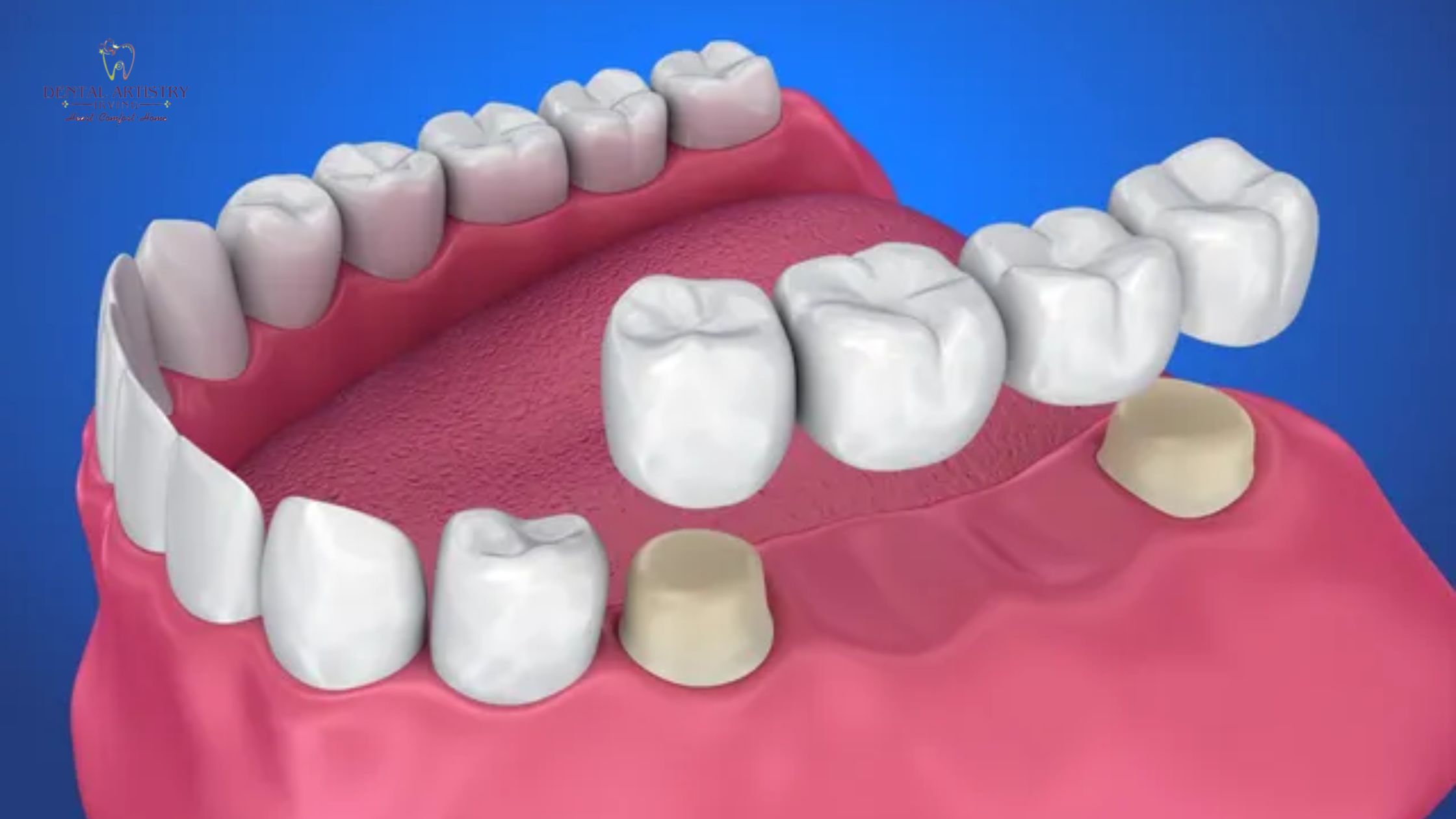 Metal-Free Crowns And Bridges Irving