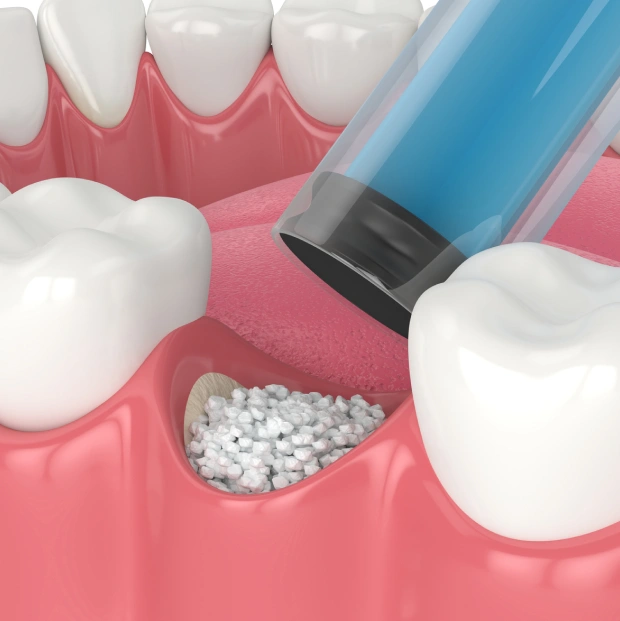 Rebuild Your Smile with Bone Grafting