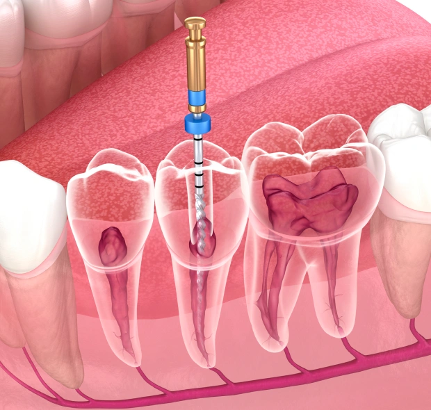 Save Your Natural Teeth with Expert Endodontic Care