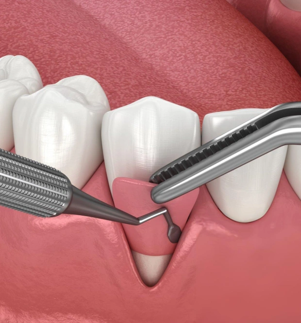 Restore Your Smile and Protect Your Gums with Gingival Grafting