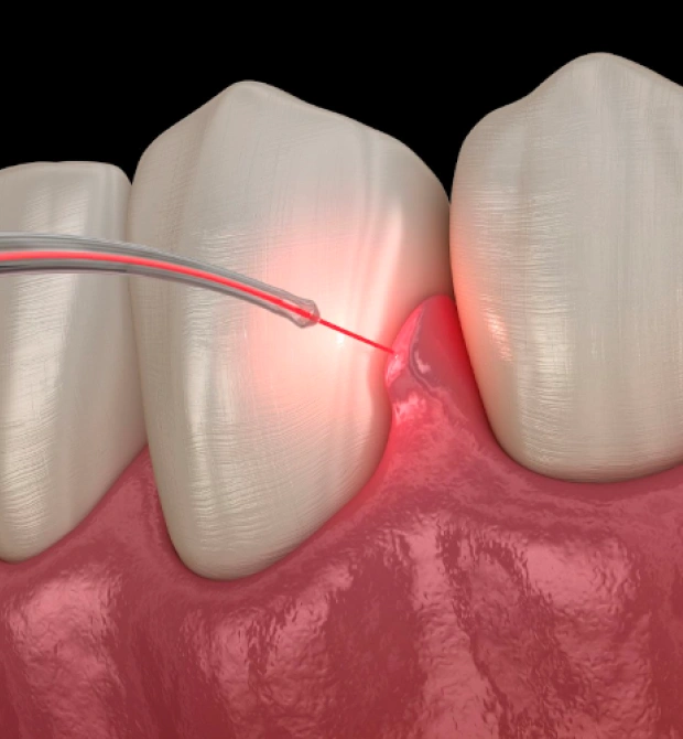 Boost Gum Health with Laser Bacterial Therapy