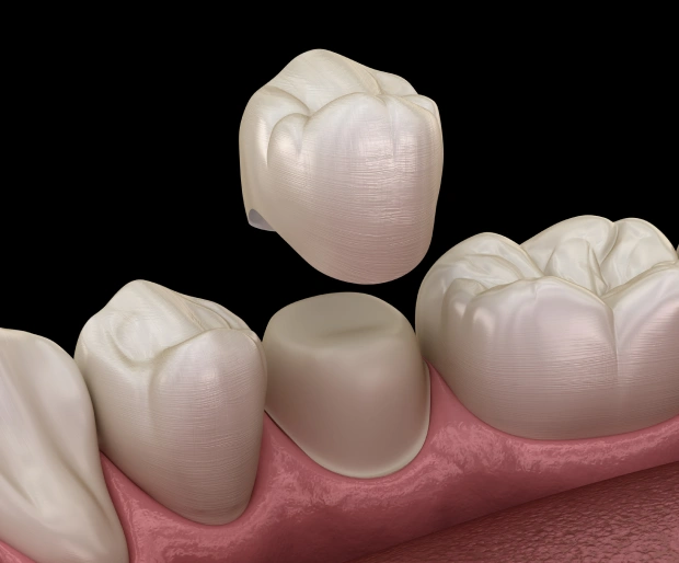 Restoring Beauty Without Metal