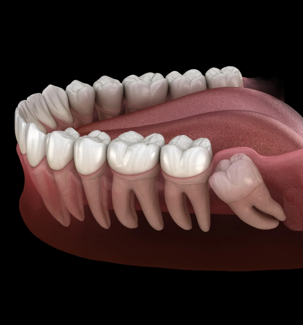 Get Relief from Wisdom Teeth Pain with Expert Care